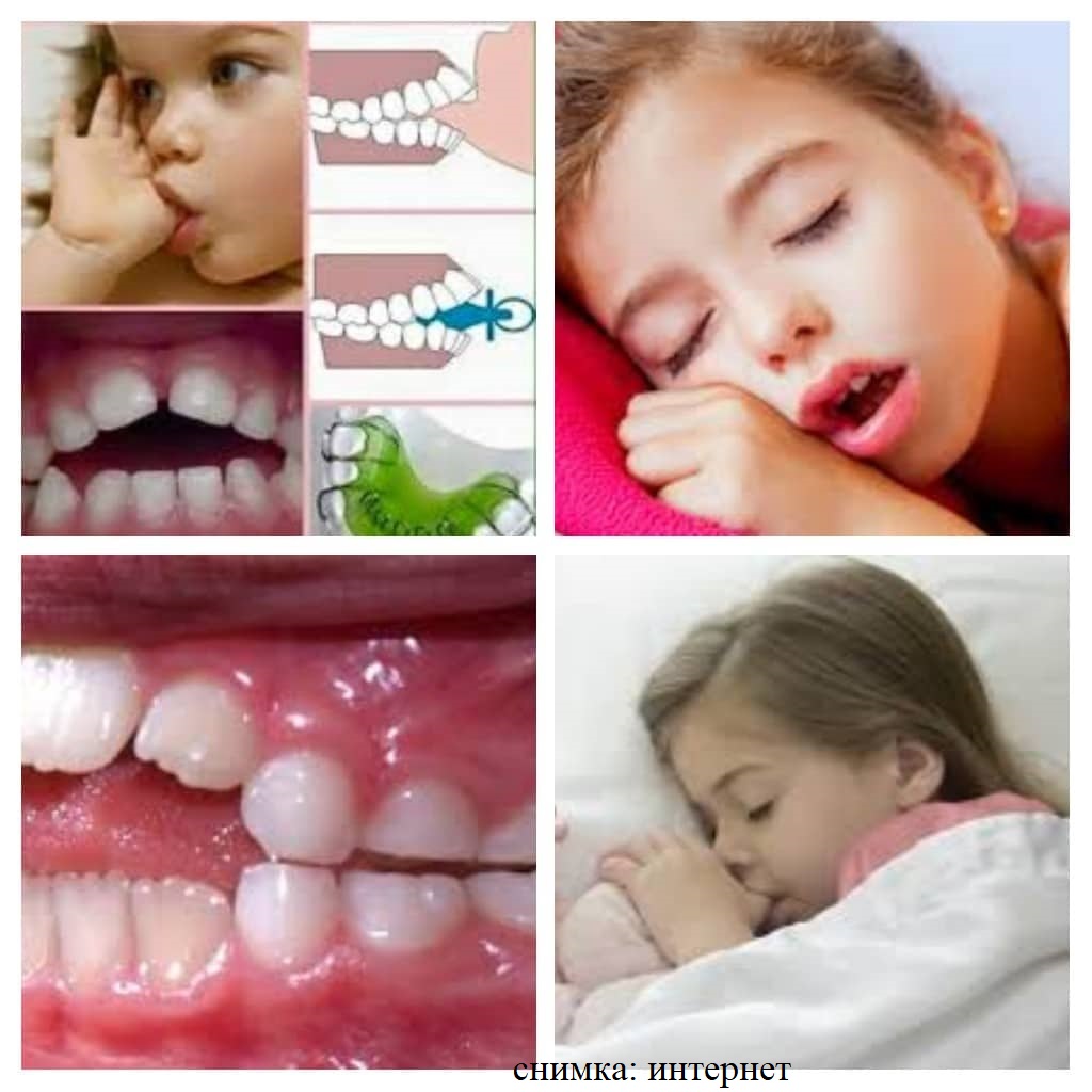 Вредни навици у децата - смукане на пръст, продължителна употреба на биберон  и дишане през устата. 